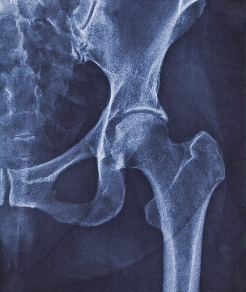 X-ray image of hip joint with signs of coxarthrosis.